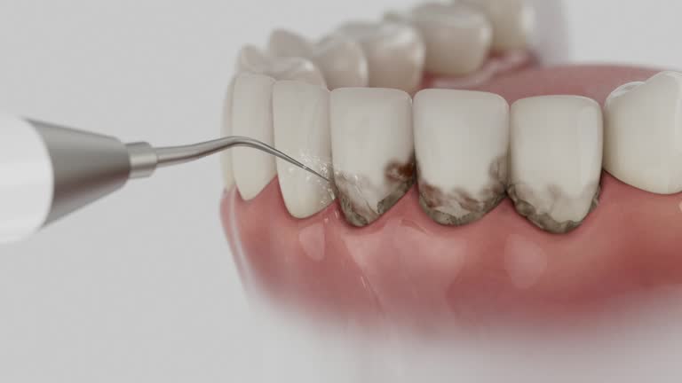 Trusted Wisdom Tooth Removal service in Britt, IA - Dentist Open Now